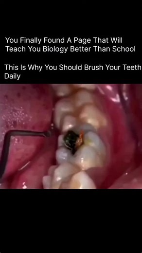 BIOLOGY | MEDICAL | HEALTH on Instagram: "Ever wondered what really happens if you skip brushing? Here’s the truth ⬇️ 🔹 Removes plaque – Every day, bacteria form a sticky layer called plaque. Brushing breaks it down before it turns into hard tartar. 🔹 Prevents cavities – Food particles + bacteria = acid. Brushing neutralizes this acid and protects your enamel. 🔹 Keeps gums healthy – Daily brushing prevents gum inflammation, bleeding, and gum disease. 🔹 Stops bad breath – No brushing = bacter