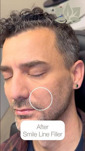 How Smile Line Filler Looks on Men | Before & After by Lushful Aesthetics