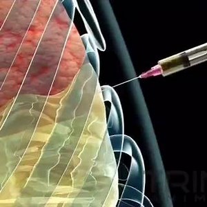 10K views · 29 reactions | Thoracentesis or pleural tap, is an...