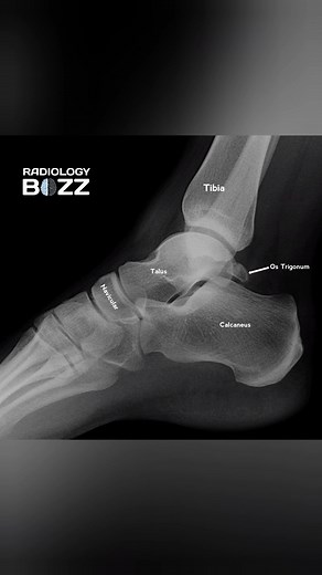 Ever noticed this tiny extra bone behind the talus? 👀 That’s the Os Trigonum — a normal accessory bone found in some people, visible here beautifully on X-ray, CT, and MRI. Though usually harmless, it can sometimes cause posterior ankle pain or Os Trigonum Syndrome in athletes and dancers 🩰⚽ 📸 Modalities: 1️⃣ X-ray – clearly showing the bony outline 2️⃣ CT – precise bone detail 3️⃣ MRI – soft tissue evaluation and inflammation check --- 🩻✨ Radiologist’s Point of View: The Os Trigonum is an a