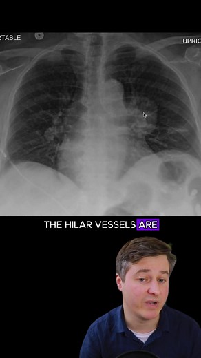 Understanding the Hilum Overlay Sign in Chest X-Ray Interpretation