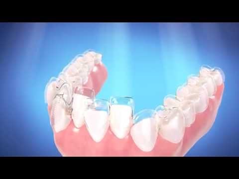 How Invisalign Works