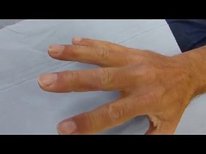 Ganglion Cyst Removal