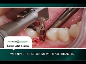 Two-Stage Surgical Technique: Placement in the Mandibular Right First Molar