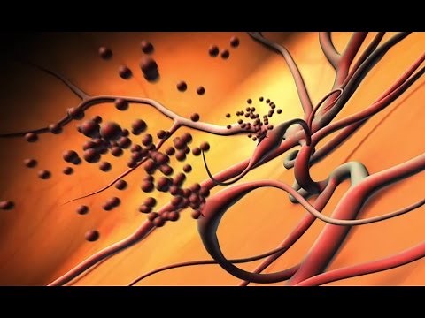 Lucentis effective for proliferative diabetic retinopathy