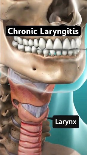 Chronic Laryngitis Explained (3D Animation)