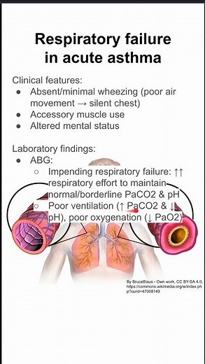 Respiratory failure in acute asthma