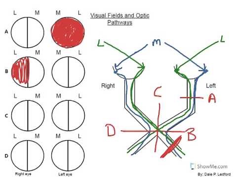 How to Biology & Anatomy: Optic pathways, visual fields and the lesions