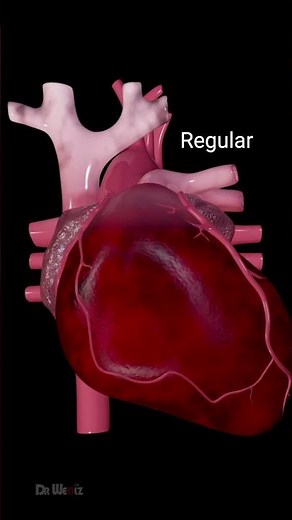 Heart Arrhythmias: Different Types and Symptoms