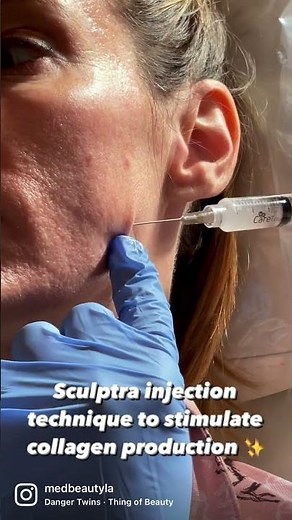 Sculptra Injection Technique