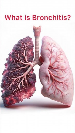 BRONCHITIS: THE CONDITION, ITS TYPES AND TREATMENT #bronchitis #shortsfeed #lungproblems