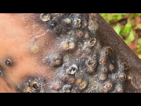 Peter Ogweri's follow up dejiggering - see long video @ riseupsociety.net & ruskenya.org