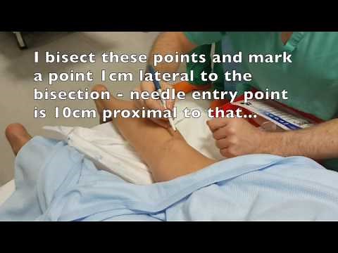 Popliteal block - posterior approach