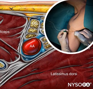 Ultrasound-Guided Axillary Brachial Plexus Block - NYSORA