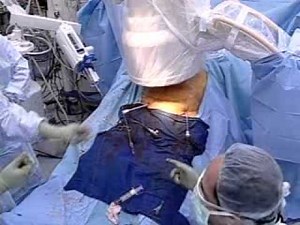 Endovascular Abdominal Aortic Aneurysm Repair