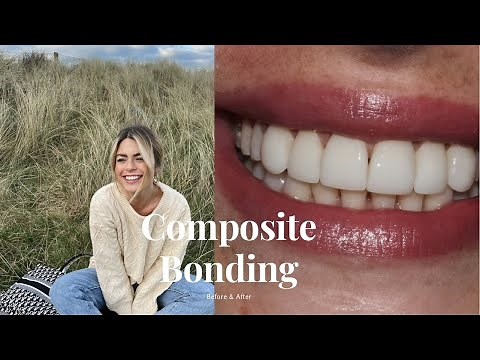 MY COMPOSITE BONDING EXPERIENCE. BEFORE & AFTER!