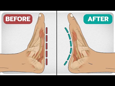 5 Exercises To Fix Flat-Feet (Fallen Arches)