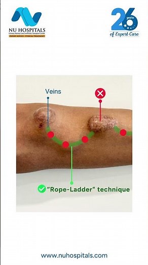Small Changes in AVF Needling, Big Difference in Safety | Rope Ladder Technique | Dr Krishna Prasad