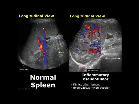 Spleen Ultrasound Normal Vs Abnormal Image Appearances Comparison | Splenic Pathologies On USG