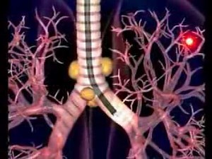 Video Assisted Thoracoscopic Surgery