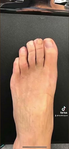 Fixing Crossover Toes and a Bunion 💫