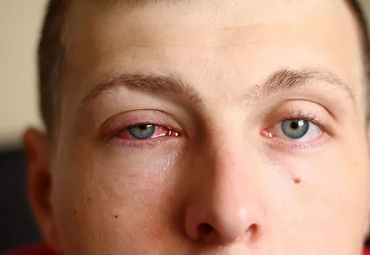 Here’s How To Get Rid of Pink Eye Fast