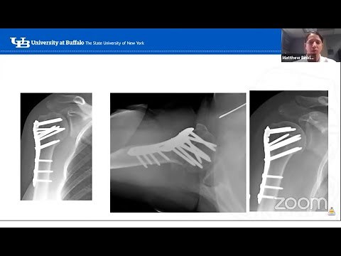 Proximal humerus fractures