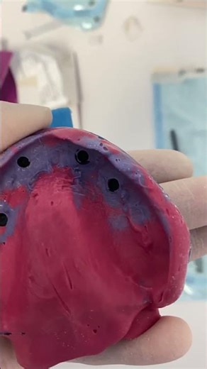 🦷 Final Impression for Overdenture