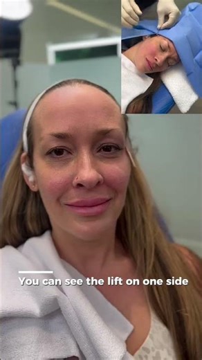 Invislift Thread Lift Results with Dr. Godley in Vancouver