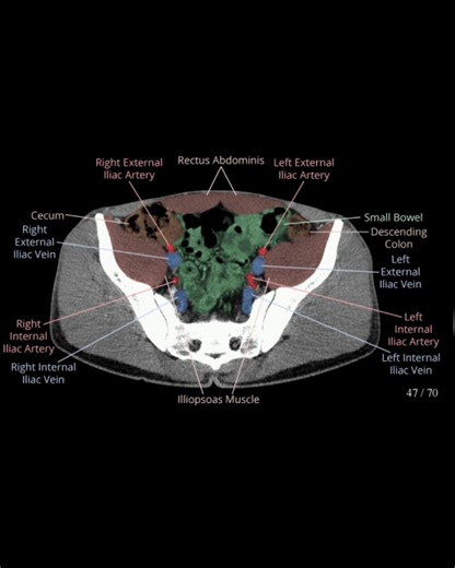 CT Whole Abdomen axial anatomy | CT Scan and MRI study