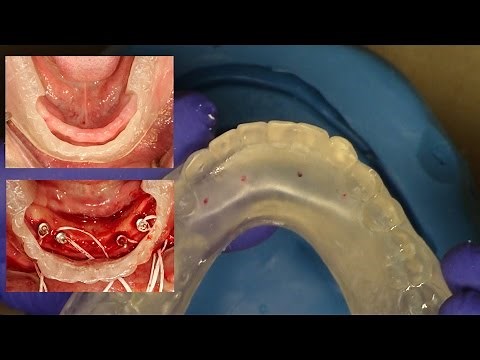 Easy Clinical & Laboratory Technique for Fabricating an "In-House Surgical Guide" for Overdentures