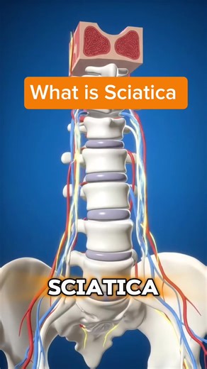 Understanding Sciatica: Causes and Relief Methods