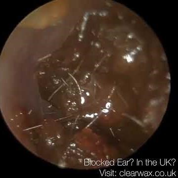 9 Months of Ear Wax Build-Up Removal #audiology #earwaxremoval