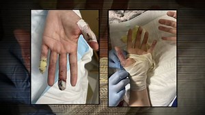 Mommy makeover gone wrong: Woman warns of medical tourism dangers after 'permanently disfigured'