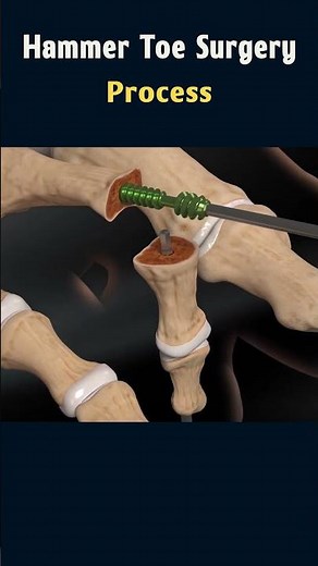 Hammer Toe Surgery: Understanding the Procedure #surgeryanimation