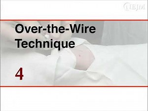 Placement of an Arterial Line