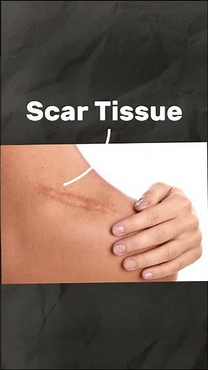 MPS Therapy Explained: Using Microcurrent for Muscle Relaxation & Scar Tissue Treatment