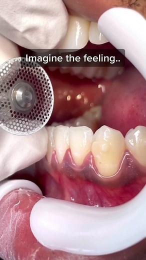 Discover the Process of IPR in Orthodontics