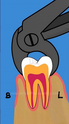 Extraction of Broken Root Piece #drteeth #dentistry