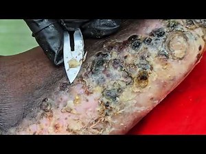 Timina Rasoa's jigger dig - watch long video @ riseupsociety.net & ruskenya.org