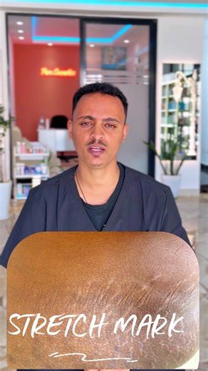How to remove a stretch marks