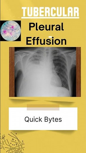 TB Pleural Effusion: Which Test Really Delivers the Diagnosis?