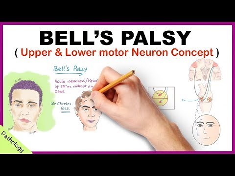 Bell's palsy Upper and Lower Motor Neuron Lesions - Simplified