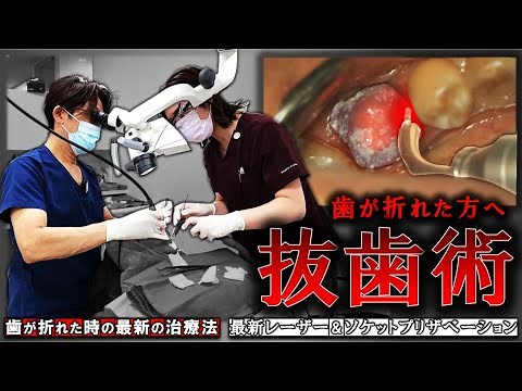 [Latest Tooth Extraction Technique] If your tooth breaks, protect your bone! Socket preservation ...