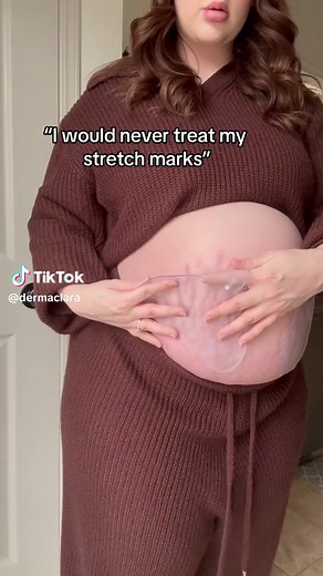 Reduce Stretch Marks Safely and Effectively | Expert Tips