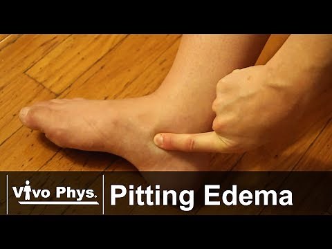 Pitting Edema - Example