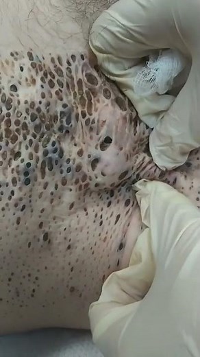 Nevus Comedonicus removal