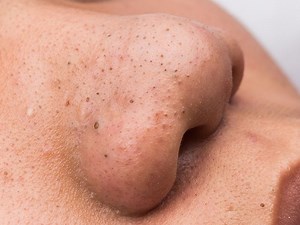 Deep blackheads: Causes, treatment, and prevention