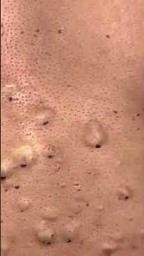 A Belly Full Of Steatocystomas!