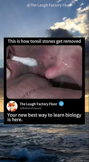 This is how tonsil stones are removed 🥢 | MDCT